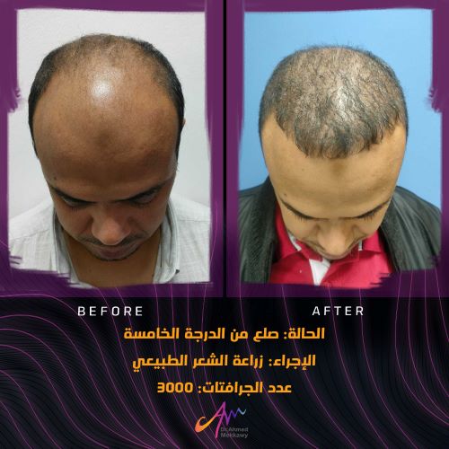 مميزات زراعة الشعر